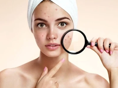 Tại sao dùng sữa rửa mặt lại nổi mụn và cách khắc phục hiệu quả