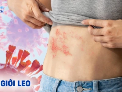 Vì sao bị giời leo? Nguyên nhân, dấu hiệu và cách xử lý hiệu quả