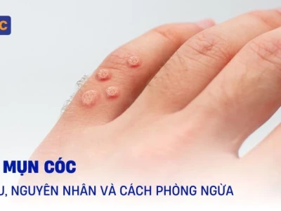 Vì sao bị mụn cóc và cách điều trị hiệu quả
