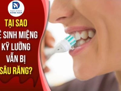 Vì sao bị sâu răng? Nguyên nhân, triệu chứng và cách phòng ngừa hiệu quả