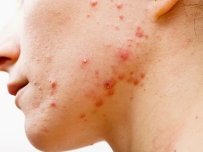 Vì sao bị viêm nang lông và cách xử lý hiệu quả
