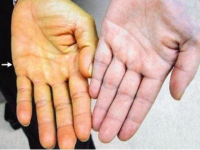 Vì sao da bị vàng biểu hiện và cách khắc phục?