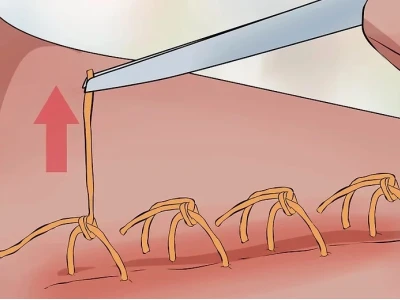 Vì sao không được để sót chỉ khâu? Nguy cơ và cách xử lý