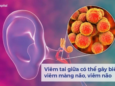 Viêm tai giữa: Nguyên nhân và cách điều trị hiệu quả cho mọi lứa tuổi