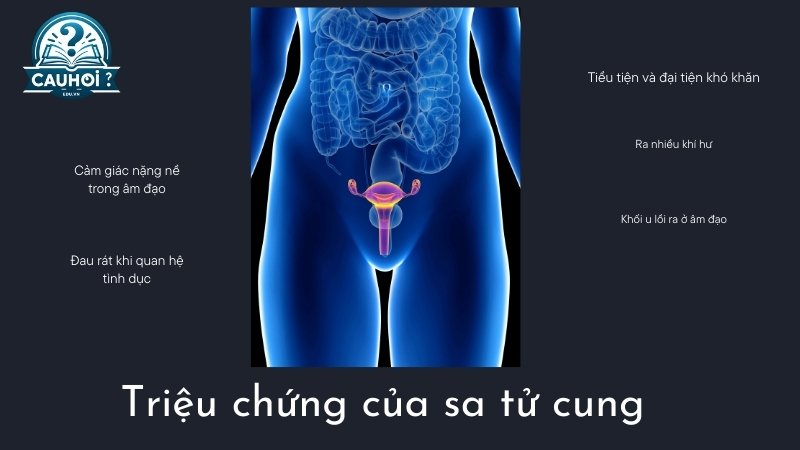 Triệu chứng của sa tử cung