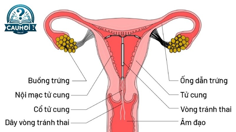 Hiểu biết về vòng tránh thai