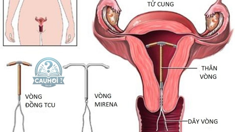 Nguyên nhân khó thụ thai sau khi tháo vòng