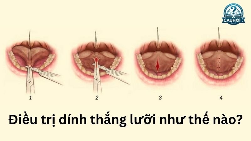 Điều trị dính thắng lưỡi 