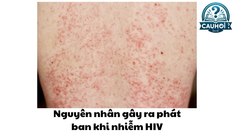 Nguyên nhân gây ra phát ban khi nhiễm HIV