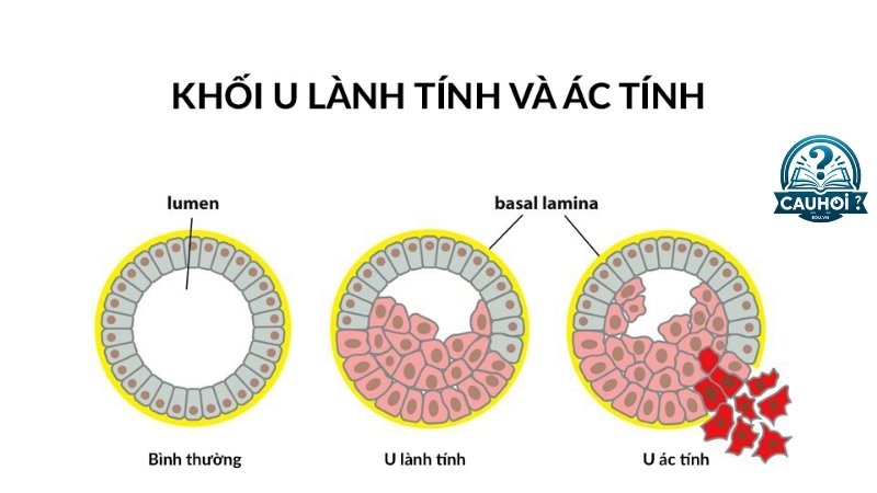 Lựa chọn điều trị và tiên lượng