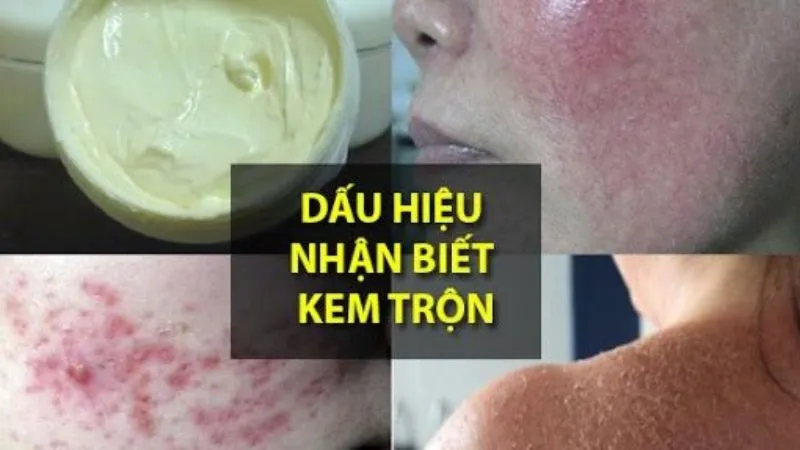 Cách khắc phục và chăm sóc da bị tổn thương do kem trộn