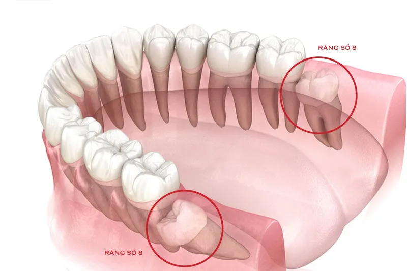 Tác hại của răng số 8 1