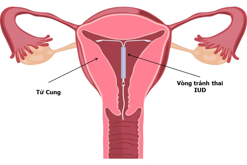 tác hại đặt vòng tránh thai 2