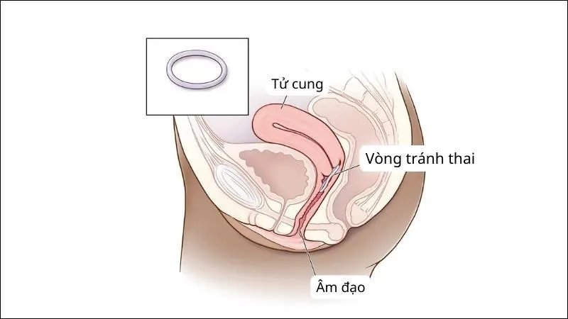 tác hại đặt vòng tránh thai 4