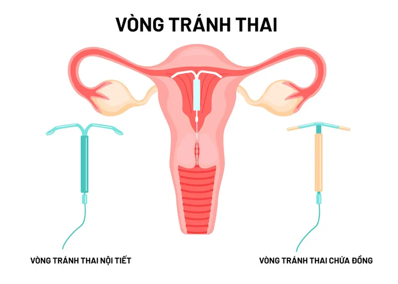 tác hại đặt vòng tránh thai 8