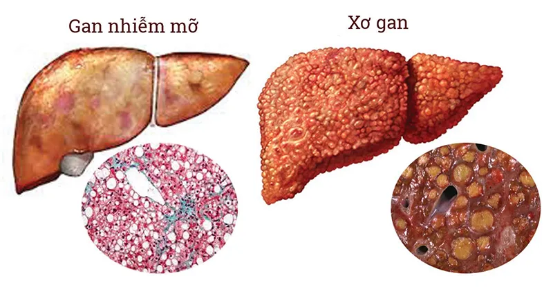 Tác hại của men gan cao 2