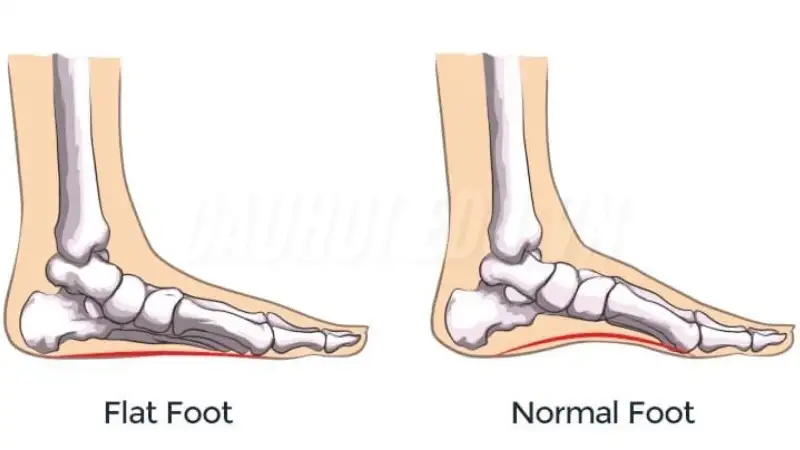 Khắc phục bàn chân bẹt như thế nào? 2